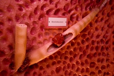 Neoplasie